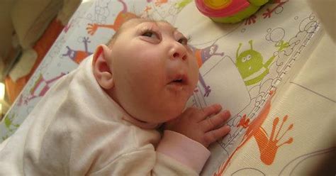 Baby with extreme anencephaly (born without a brain) : r/WTF