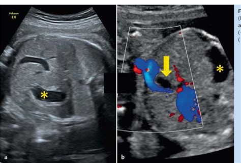 Umbilical Vein