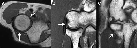 MR Imaging of the Elbow - Magnetic Resonance Imaging Clinics