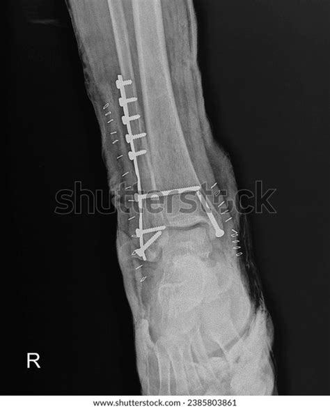 4 Bimalleolar Fracture Treatment Images, Stock Photos, 3D objects ...