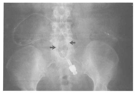 Figure 1 from Malfunction of Tenckhoff catheter due to a rare kink. | Semantic Scholar