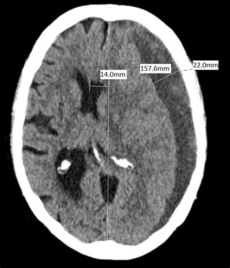 Cureus | Minimally Invasive Subacute to Chronic Subdural Hematoma Evacuation with Angled ...