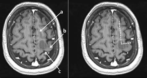 Central sulcus – Radiology Cases