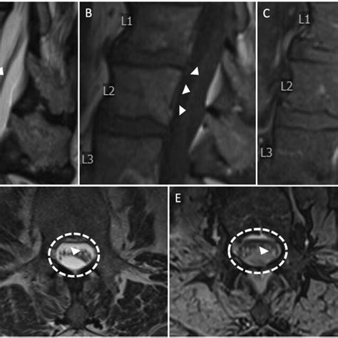 A-E. MRI imaging obtained in patient with right paraspinal abscess with... | Download Scientific ...