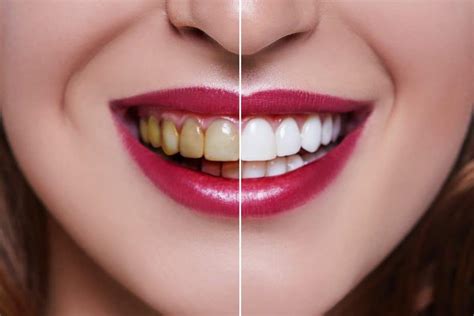 Laser Whitening in Tijuana | Dr. México Dentist Center