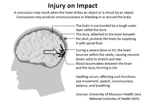 Concussion - Memory Loss Cause - MemoryHealthCheck