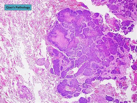 Flickriver: Photoset 'Basaloid squamous cell lung carcinoma' by Qiao's Pathology (Art and ...