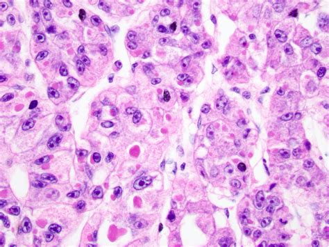 Hepatocellular Carcinoma Histology