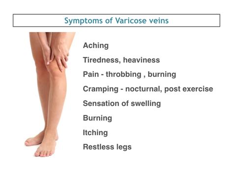 Symptoms Of Varicose Veins explained by Dr. Avinash Katara Minimal ...