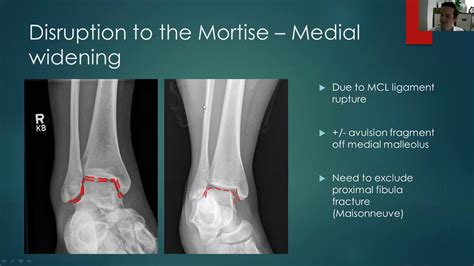 Ankle x-ray interpretation - YouTube