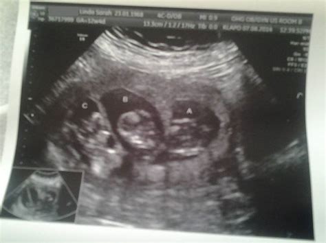 Ultrasound pic of T&A's triplets at 12weeks 3days being carried by ...