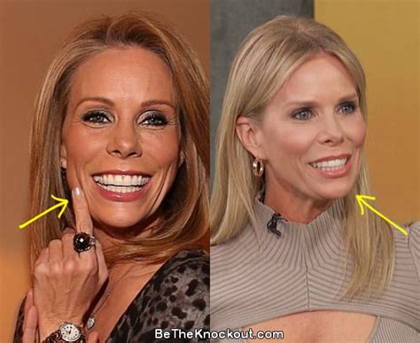 Cheryl Hines Plastic Surgery Comparison Photos