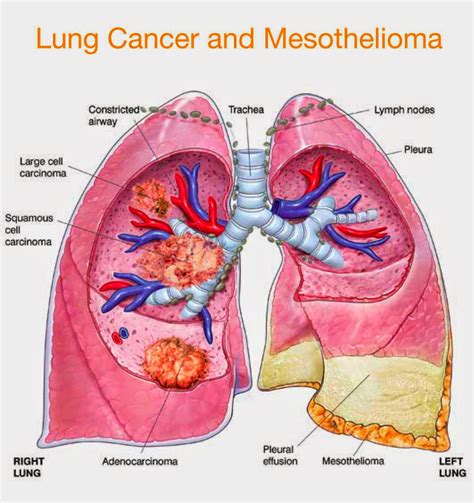 Medical Treatment Pictures-for Better Understanding: Malignant Mesothelioma Symptoms: How to ...