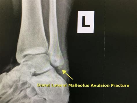 Avulsion Fractures