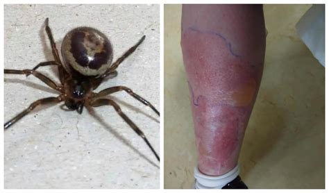 Black Widow Spider Bite Images / Common Spider Bite Symptoms Household ...