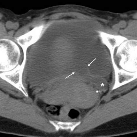 Complicated ureterocele with ureterolithiasis and recurrent urinary ...