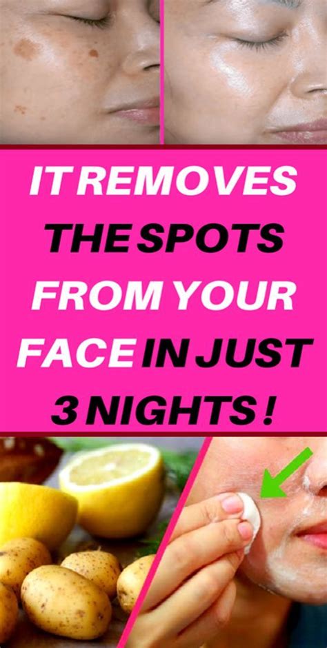 SIMPLE TRICK TO REMOVE BROWN SPOTS FROM YOUR SKIN | Brown spots on face ...