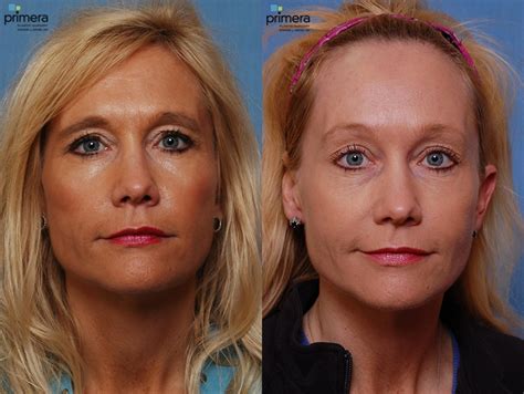 Endoscopic Forehead Lift Before and After Pictures Case 27 | Orlando, Florida | Primera Plastic ...