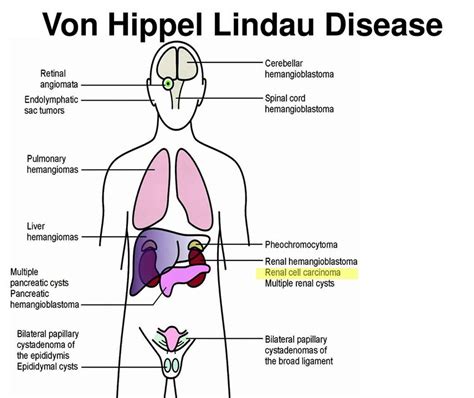 Von Hippel-Lindau syndrome causes, symptoms, diagnosis & treatment