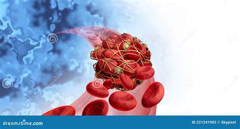 Blood Clots, Thrombus Or Embolus With Coagulated Erythrocytes. Cartoon Vector | CartoonDealer ...