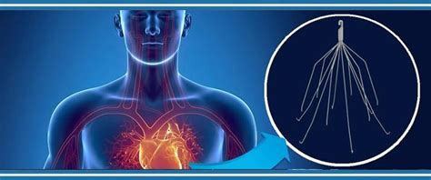 IVC Filter Removal - Crestview Hills, KY: Vascular & Interventional Associates