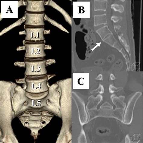 Figure 1 from The association between lumbar rib and lumbosacral transitional vertebrae ...