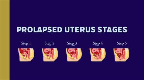 Uterine Prolapse – Causes, Symptoms, and Treatments - VIMS