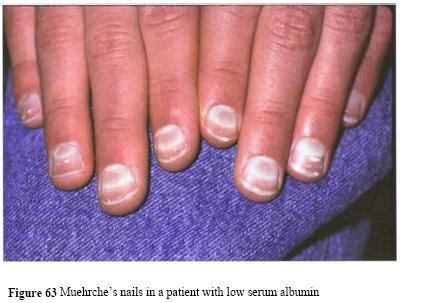 White fingernails and liver disease - Awesome Nail