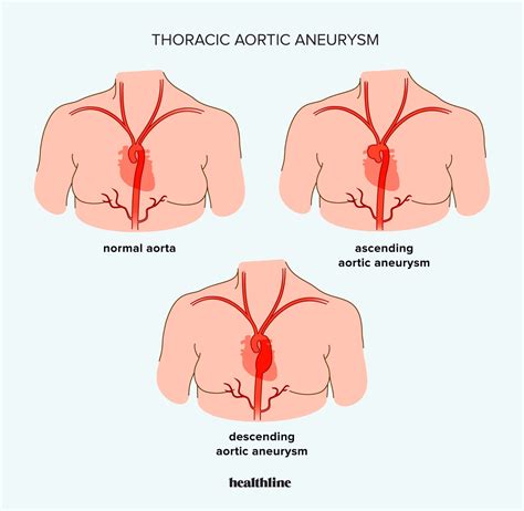 Thoracic Aortic Aneurysm: Symptoms, Causes, Treatment, More