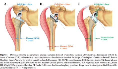 Shoulder Arthritis / Rotator Cuff Tears: causes of shoulder pain: Reverse total shoulder ...