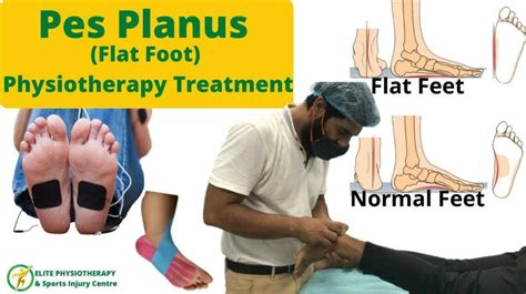 Pes Planus (Flat Foot) Physiotherapy Treatment