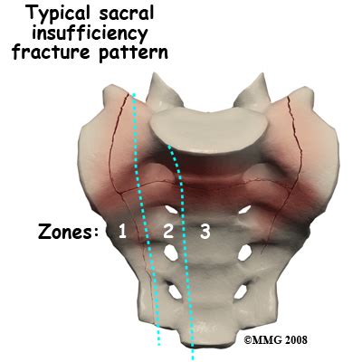 Physical Therapy in California South Bay for Sacral Insufficiency Fractures