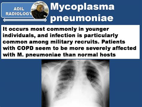 MYCOPLASMA PNEUMONIAE - Radiology Classroom