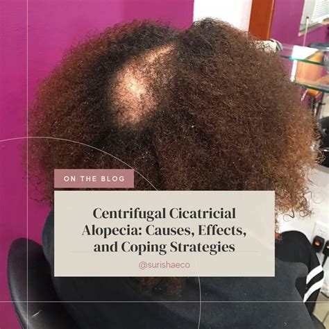 Centrifugal Cicatricial Alopecia: Causes, Effects, and Coping Strategi | Surīshae + Co