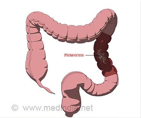 Pinworms In Humans