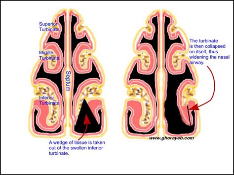 Turbinate Reduction Nasal (turbinectomy) Surgery In Iran | Medpersia Medical Tourism