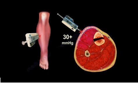 Compartment Syndrome Diagnosis and Treatment — OrthopaedicPrinciples.com