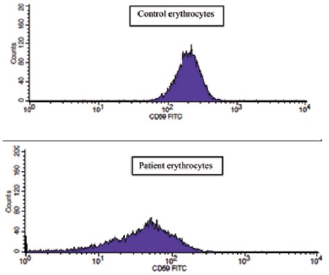 a. Diminished expression of CD59 on patient erythrocytes. | Download ...