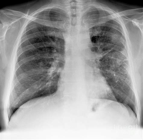 Lung Cancer, X-ray #3 Photograph by Science Photo Library - Pixels