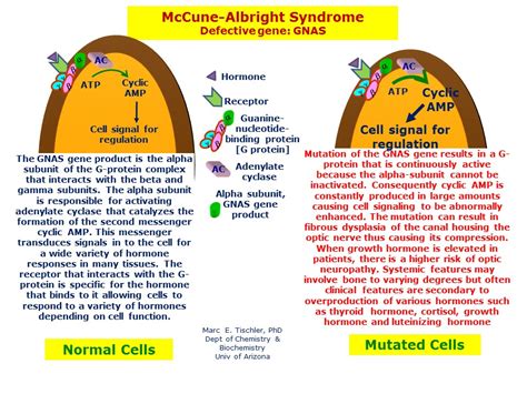 McCune-Albright Syndrome | Hereditary Ocular Diseases