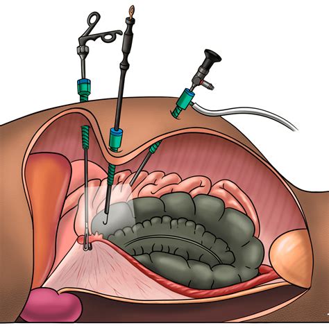 Laparoscopic Salpingectomy - Desun Hospital - Best Hospital in Siliguri ...