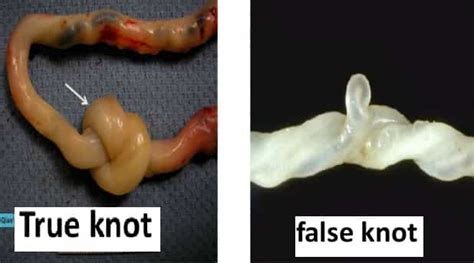 False Knot Umbilical Cord