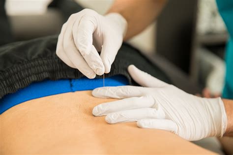 3 Benefits of Dry Needling - Physical Therapy Specialists