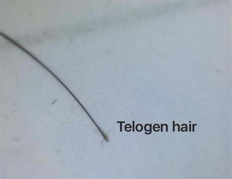 Telogen hairs: Not only in Telogen Effluvium — Donovan Hair Clinic