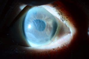 Corneal Swelling Following Cataract Surgery | Wills Eye Hospital