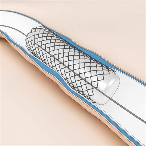 What is a Sirolimus Stent? (with pictures)