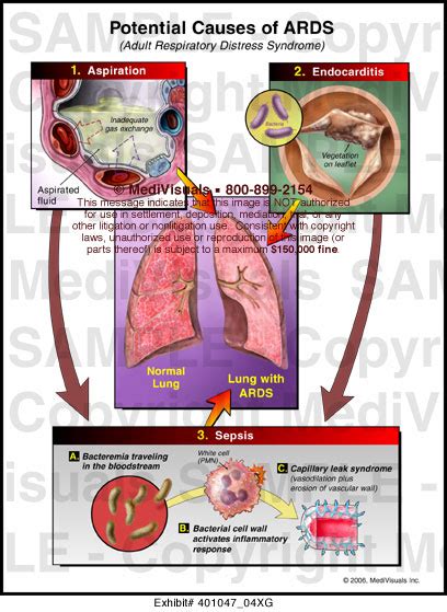 Medivisuals Potential Causes of ARDS Medical Illustration