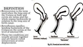 Retroverted Uterus Exercises