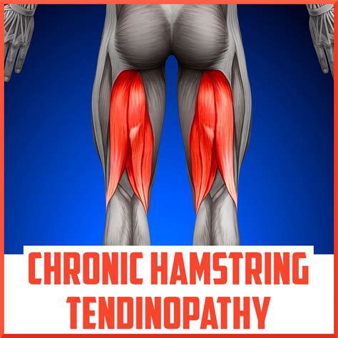 Chronic Hamstring Tendinopathy: A Review - Sports Medicine Review