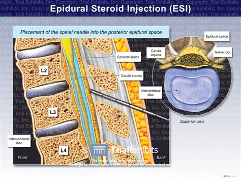 Epidural Steroid Injection (ESI) - TrialExhibits Inc.